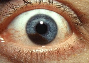 Hình ảnh ung thư mắt  Uveal Melanoma